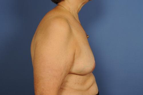 Lumpectomy Breast Reduction Before & After Image