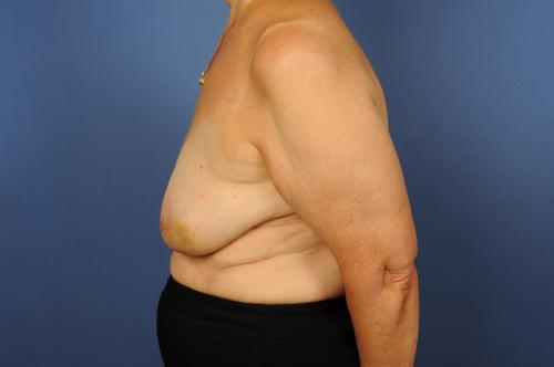 Lumpectomy Breast Reduction Before & After Image