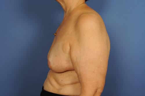 Lumpectomy Breast Reduction Before & After Image