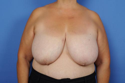 Lumpectomy Breast Reduction Before & After Image