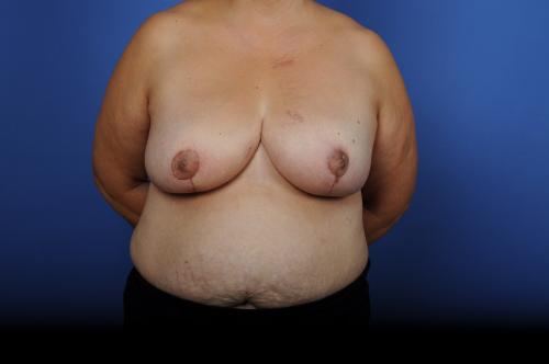 Lumpectomy Breast Reduction Before & After Image