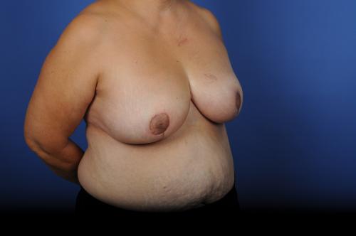 Lumpectomy Breast Reduction Before & After Image