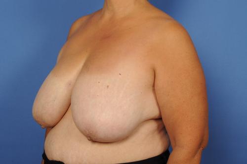 Lumpectomy Breast Reduction Before & After Image