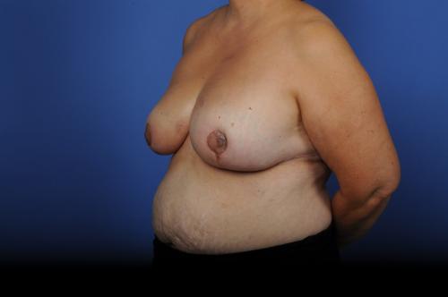 Lumpectomy Breast Reduction Before & After Image