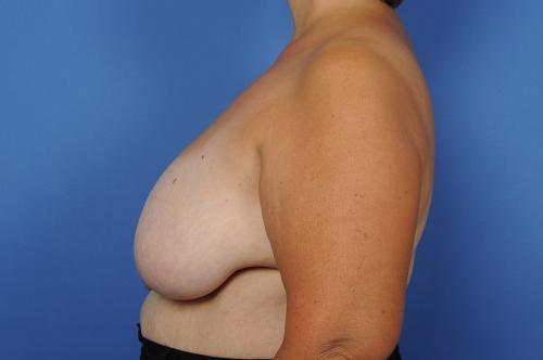 Lumpectomy Breast Reduction Before & After Image