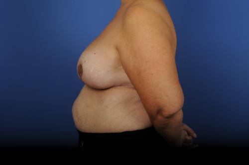 Lumpectomy Breast Reduction Before & After Image