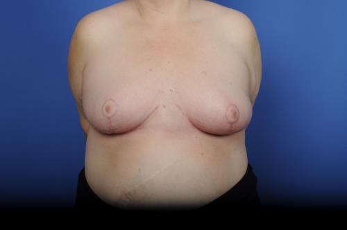 Lumpectomy Breast Reduction Before & After Image