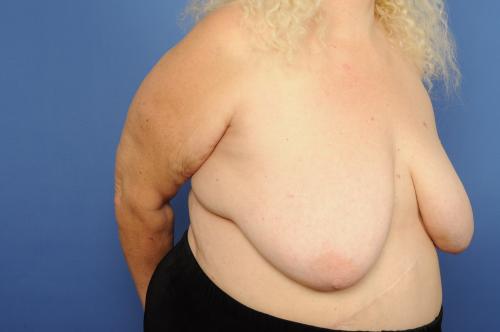 Lumpectomy Breast Reduction Before & After Image