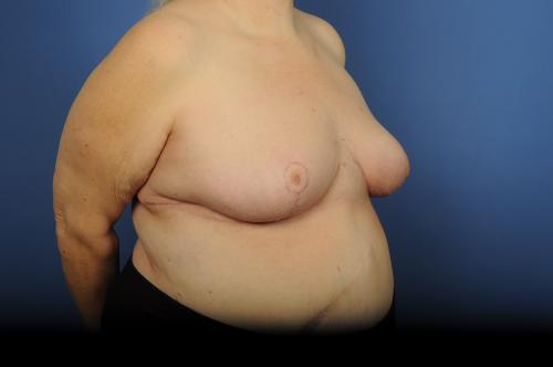 Lumpectomy Breast Reduction Before & After Image