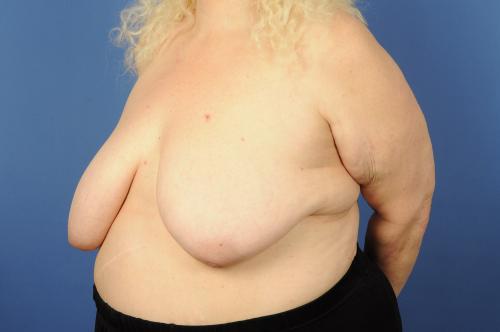 Lumpectomy Breast Reduction Before & After Image