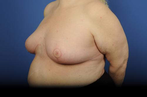 Lumpectomy Breast Reduction Before & After Image