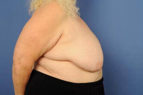 Lumpectomy Breast Reduction Before & After Image