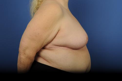 Lumpectomy Breast Reduction Before & After Image