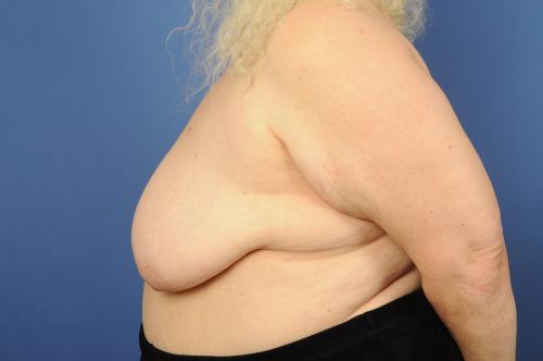 Lumpectomy Breast Reduction Before & After Image