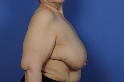 Lumpectomy Breast Reduction Before & After Image