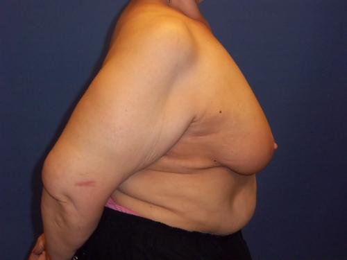 Lumpectomy Breast Reduction Before & After Image