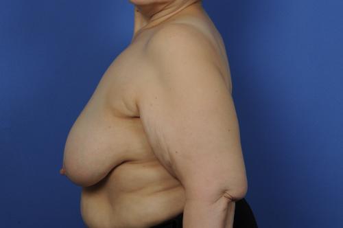 Lumpectomy Breast Reduction Before & After Image