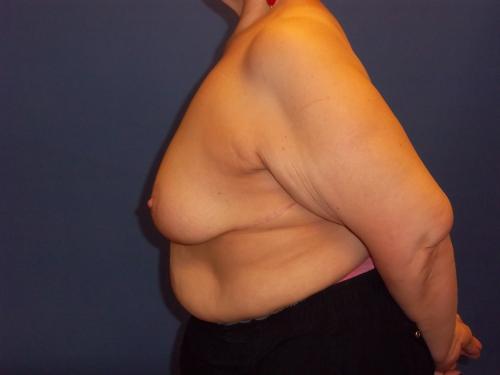 Lumpectomy Breast Reduction Before & After Image