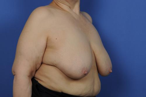 Lumpectomy Breast Reduction Before & After Image