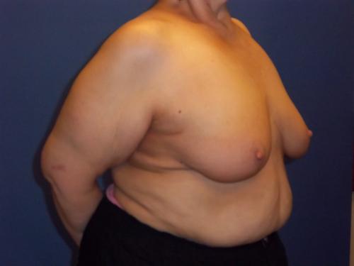 Lumpectomy Breast Reduction Before & After Image