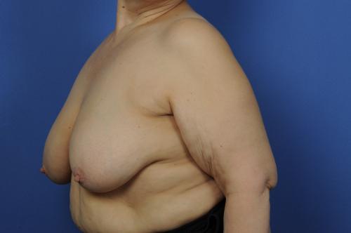 Lumpectomy Breast Reduction Before & After Image