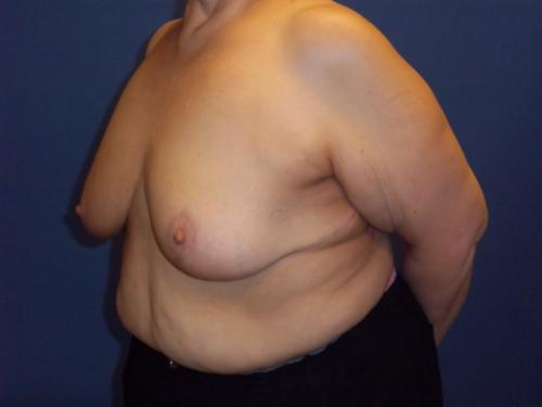 Lumpectomy Breast Reduction Before & After Image