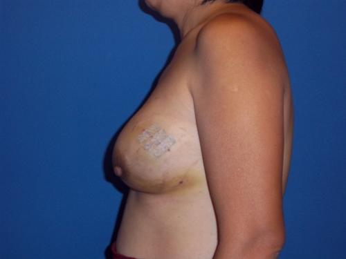 Nipple Reconstruction Surgery Before & After Image