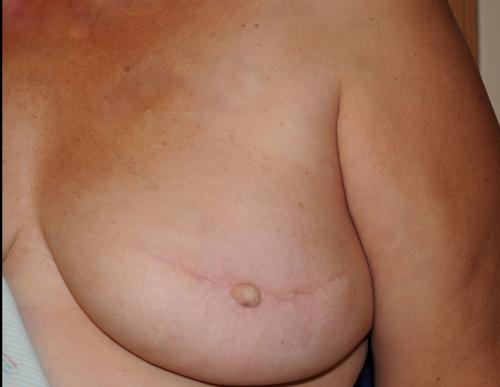 Nipple Reconstruction Surgery Before & After Image