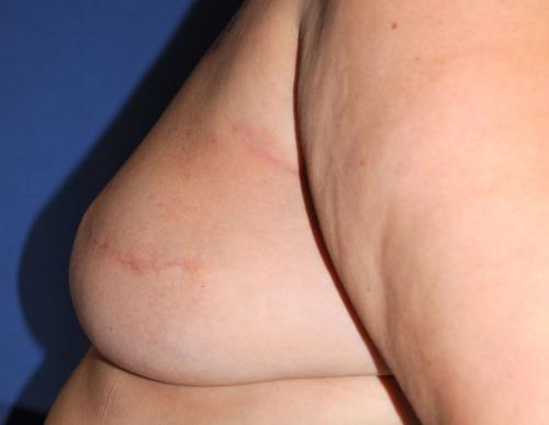 Nipple Reconstruction Surgery Before & After Image