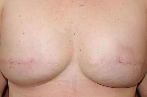 Nipple Reconstruction Surgery Before & After Image