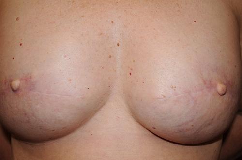 Nipple Reconstruction Surgery Before & After Image