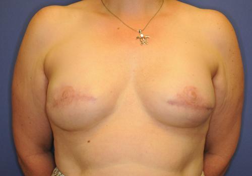 Nipple Reconstruction Surgery Before & After Image