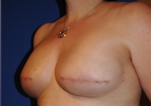 Nipple Reconstruction Before & After Image