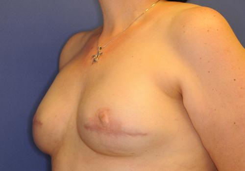Nipple Reconstruction Surgery Before & After Image