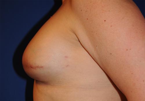 Nipple Reconstruction Surgery Before & After Image