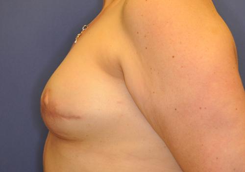 Nipple Reconstruction Surgery Before & After Image