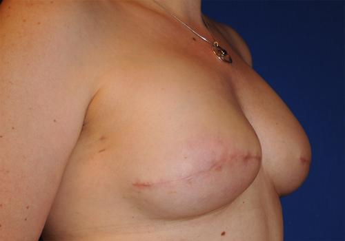 Nipple Reconstruction Surgery Before & After Image