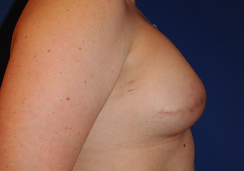 Nipple Reconstruction Surgery Before & After Image