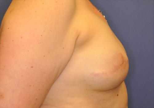 Nipple Reconstruction Surgery Before & After Image