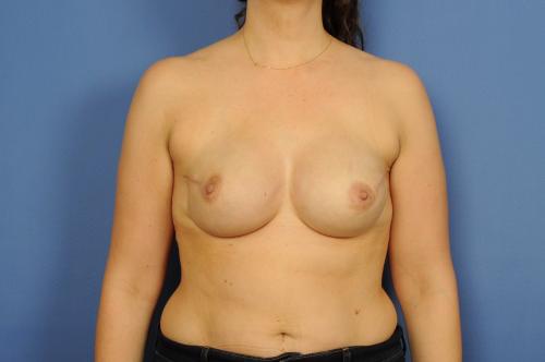 Nipple Sparing Mastectomy Before & After Image