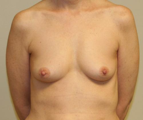 Nipple Sparing Mastectomy Before & After Image