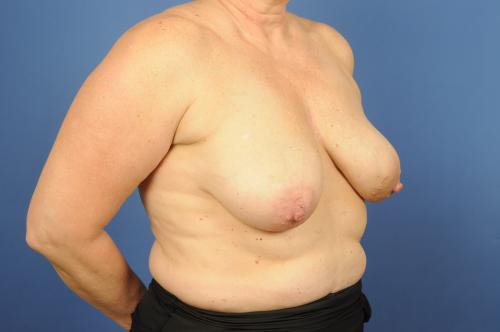 Tissue Expander Breast Implant Reconstruction  Before & After Image