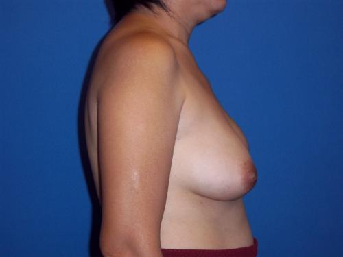 Tissue Expander Breast Implant Reconstruction  Before & After Image