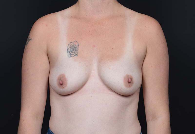 Breast Augmentation Before & After Image