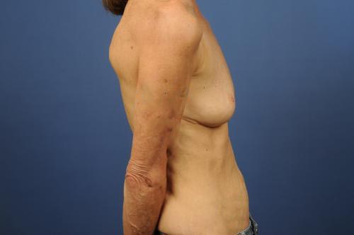 Breast Augmentation Before & After Image