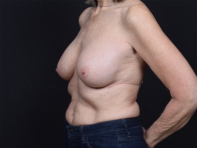 Breast Implant Revision Before & After Image
