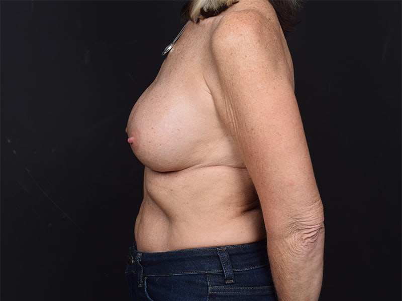 Breast Implant Revision Before & After Image