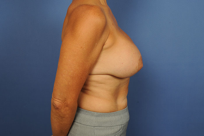 Breast Implant Exchange Before & After Image