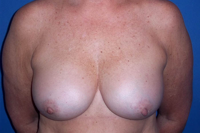 Breast Implant Revision Before & After Image