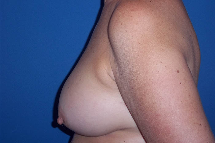 Breast Implant Revision Before & After Image